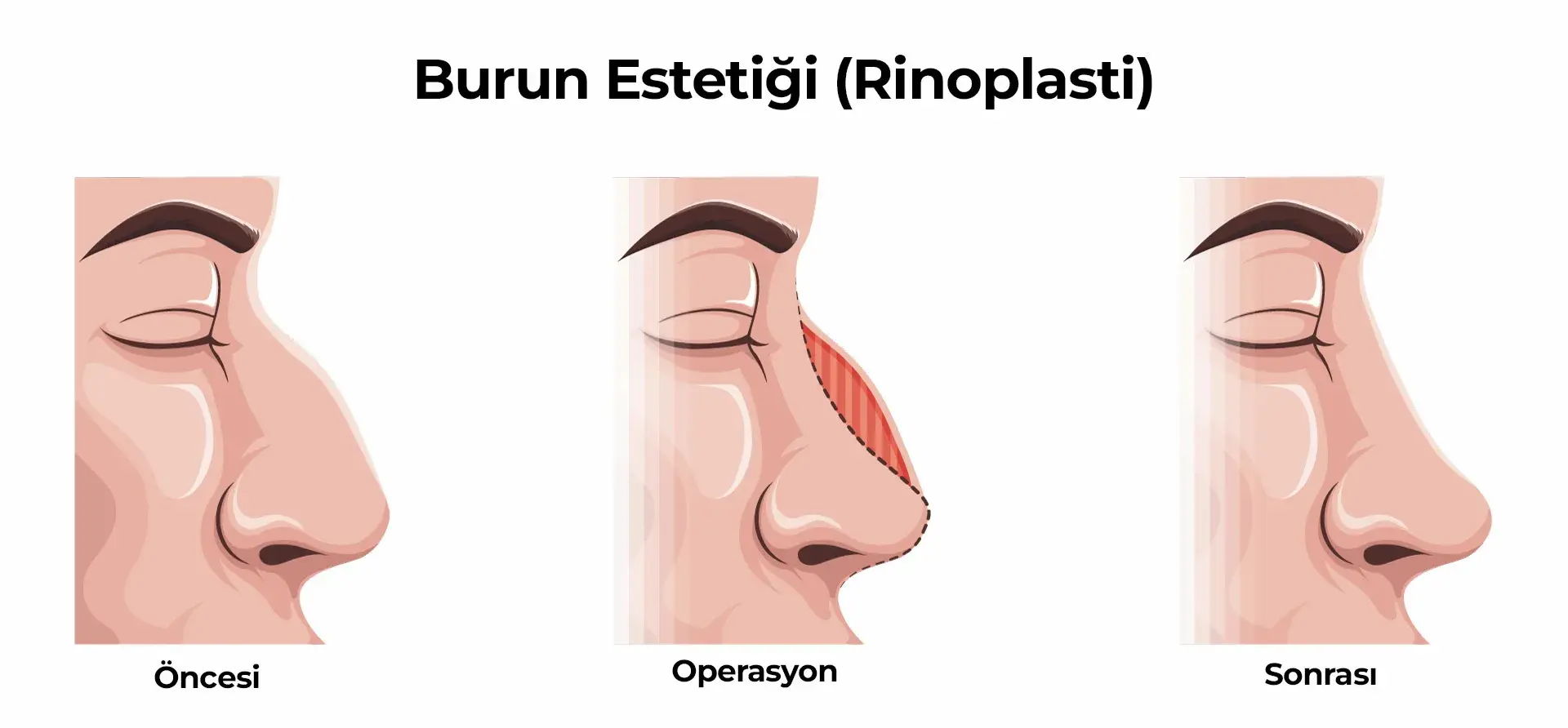 rinoplasti eskişehir