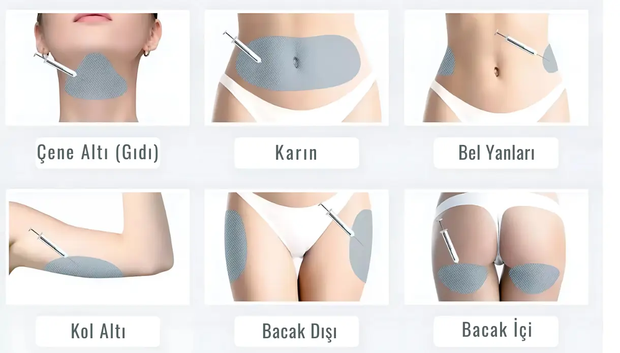 Soğuk lipoliz yaptıranların Yorumları, Lipoliz iğnesi yaptiranlar