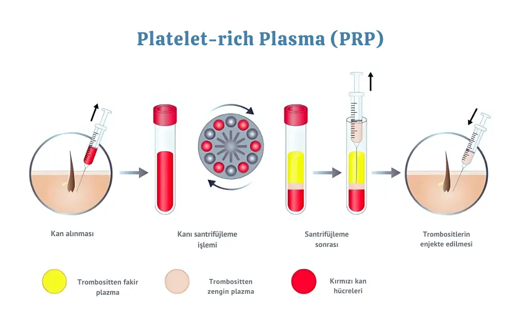 Eskişehir PRP Tedavisi 