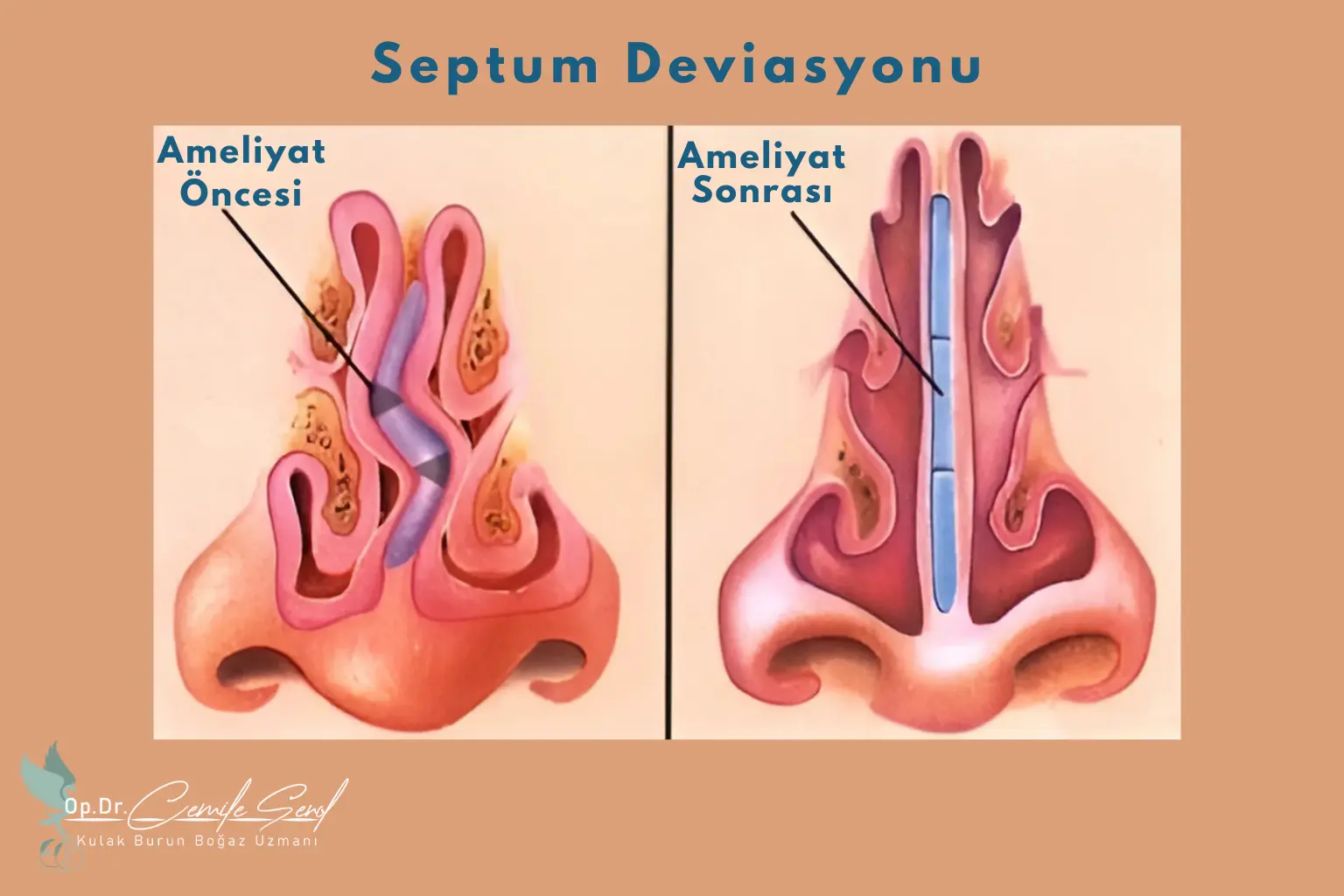 Burun Kemik Eğriliği (Septum Deviasyonu)