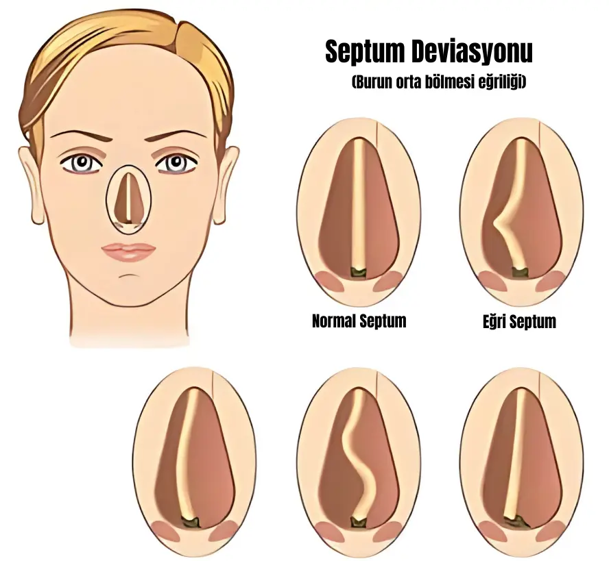 Eskişehir Septoplasti