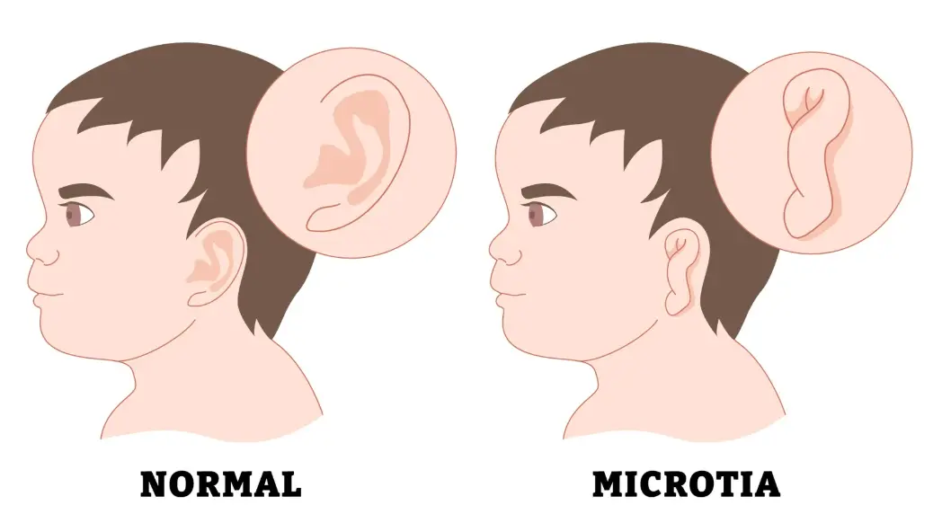 bebeklerde kulak kıvrılması nasıl düzelir kadınlar kulübü